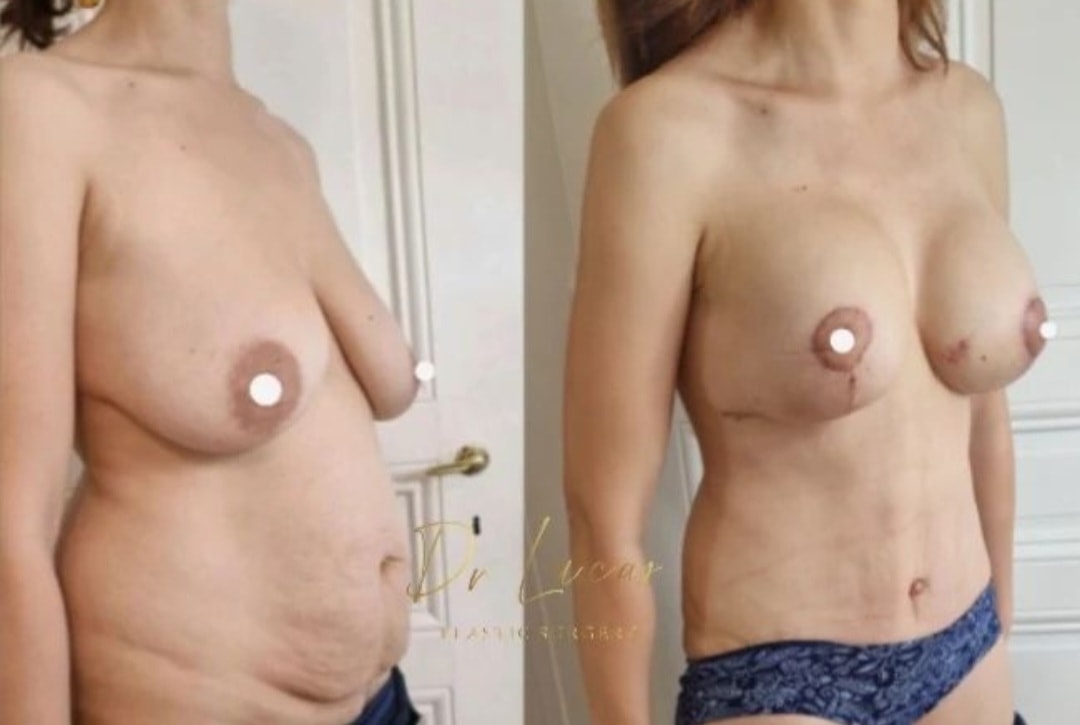 Lifting Des Seins Ou Mastopexie Dr Lucas Plastic Surgery